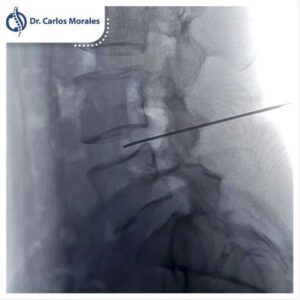 Ozonoterapia En Hernia Discal Disc Lisis Con Ozono