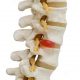 Hernia de disco - discos de la columna vertebral