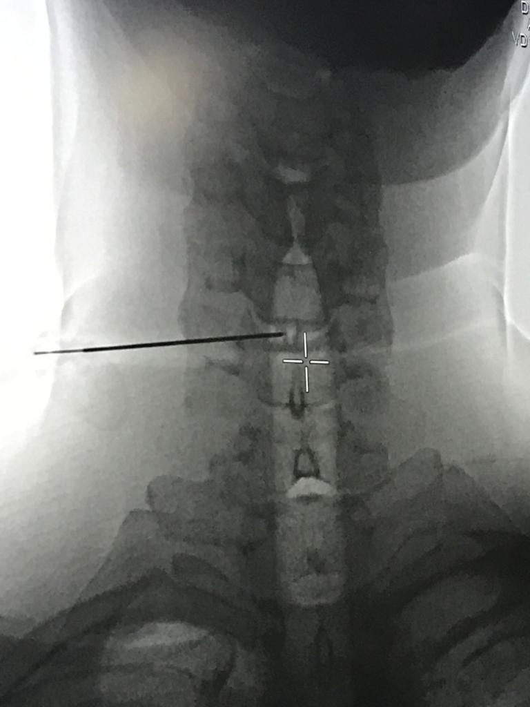 radiografía hernia discal tratamiento