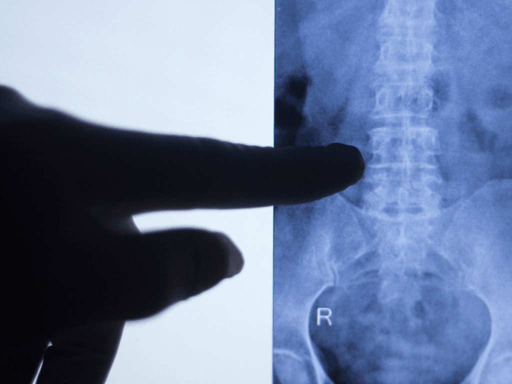 Artrosis lumbar