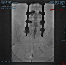 Catéter epidural con radiofrecuencia lumbar