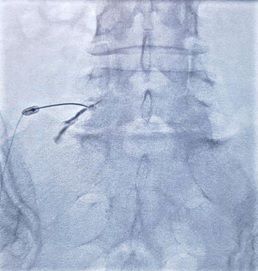 Radiofrecuencia pulsada del ganglio de la raíz dorsal