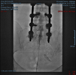 Radiofrecuencia pulsada epidural lumbar intracanal