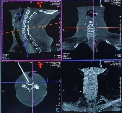 reconstrución 3D de tratamiento percutaneo de hernia discal