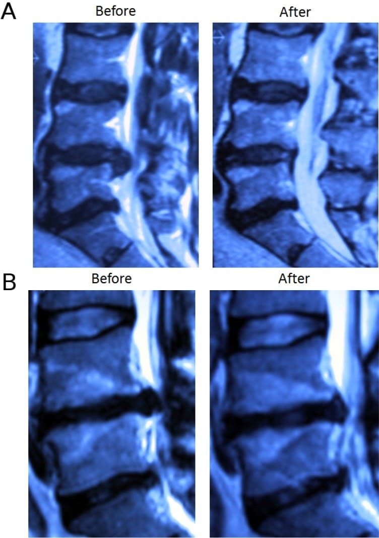 intradiscal ozono injection