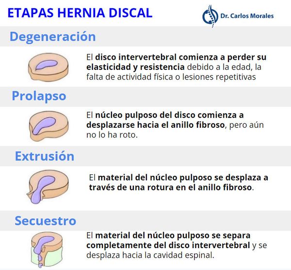Etapas de la hernia discal