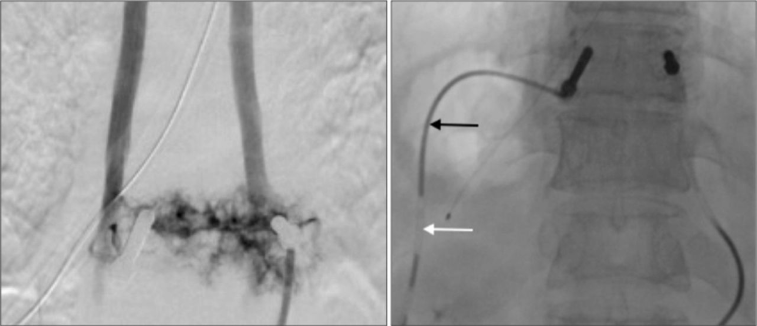 Embolización vascular de angioma