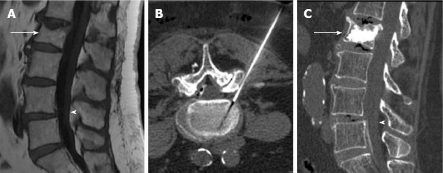 Vertebroplastia de hemangioma guiada por TAC