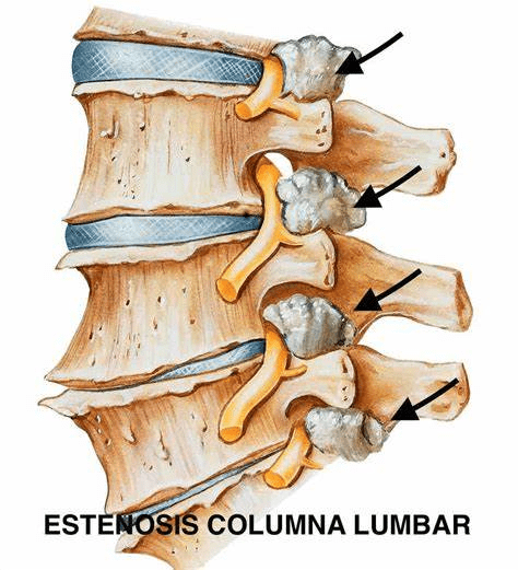 estenosis columna lumbar