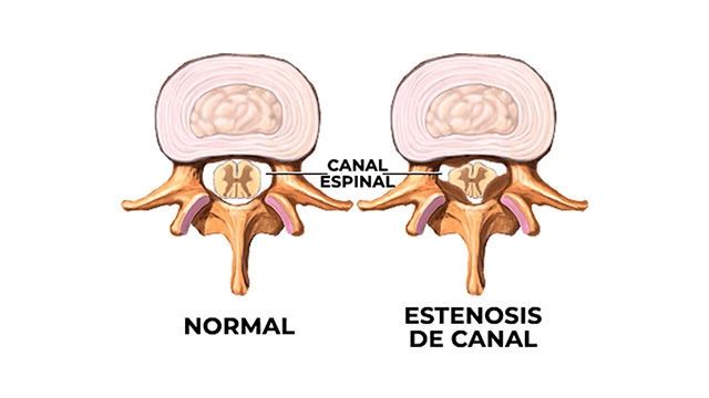 qué es la estenosis de canal