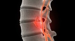 hernia discal