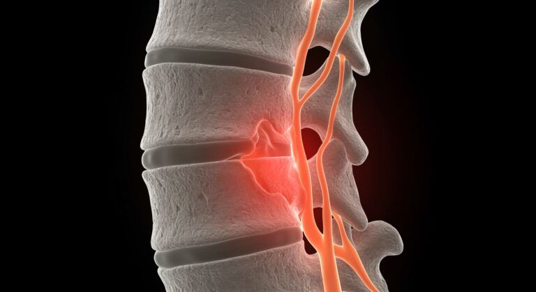 hernia discal