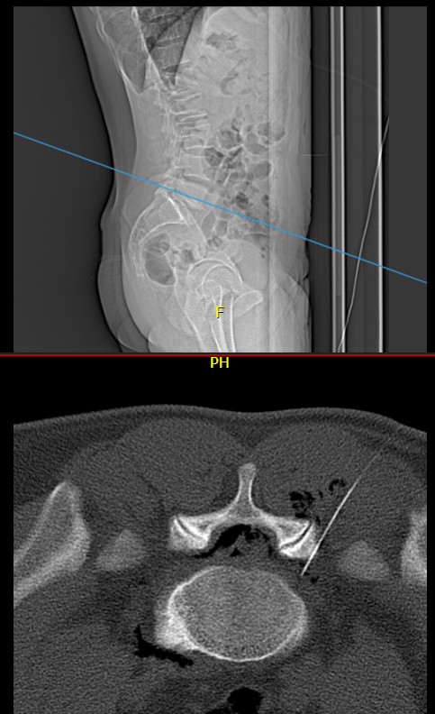 Bloqueo radicular lumbar guiado por tomografía computarizada