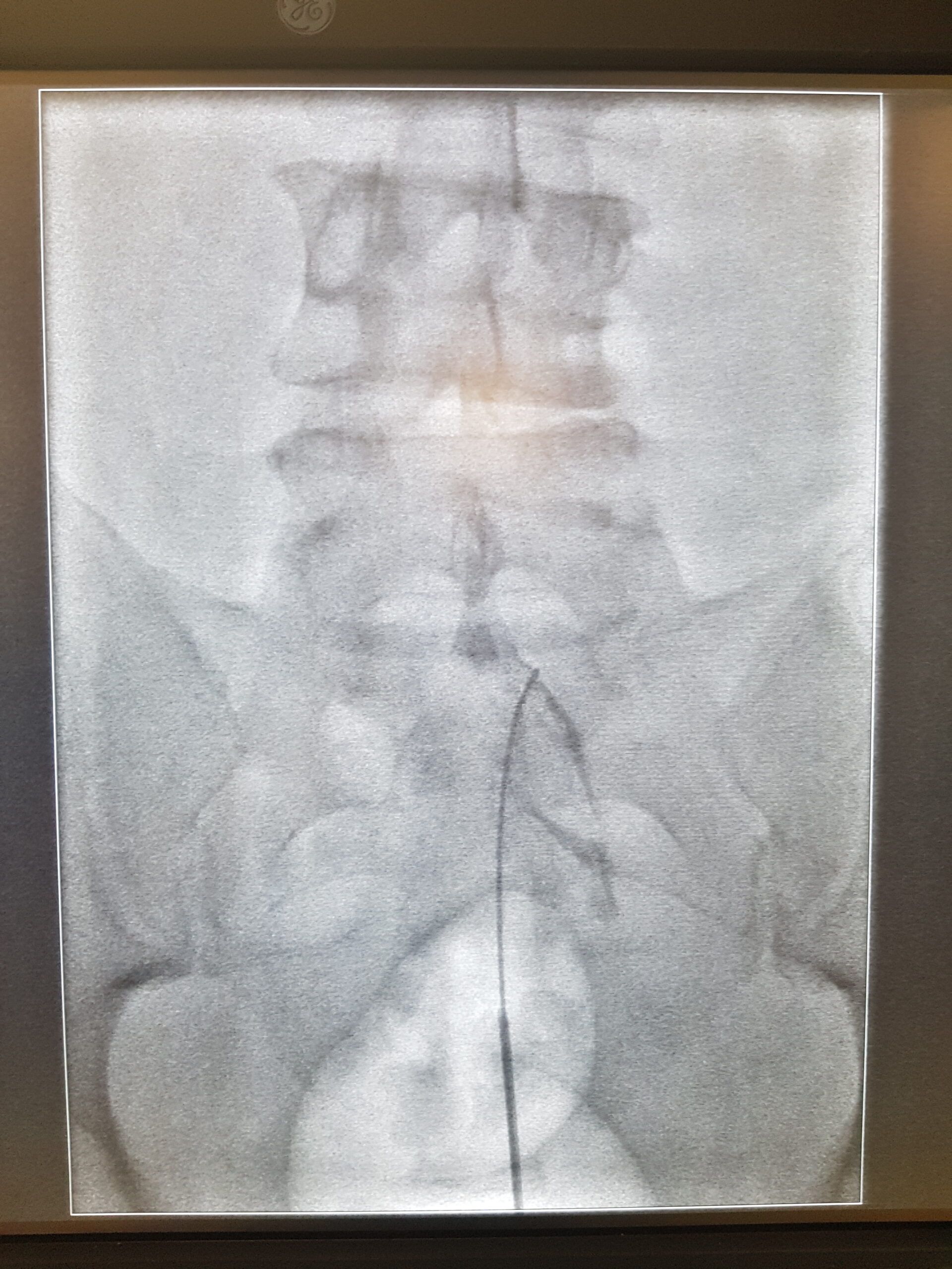 Epidurólisis con catéter guiada por fluoroscopia