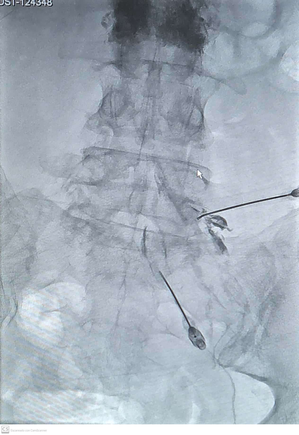 Infiltración foraminal lumbar L5-S1 guiada por fluoroscopia